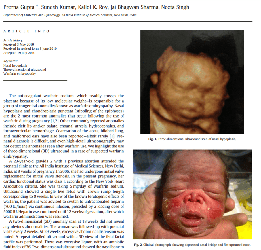 Prenatal diagnosis of warfarin embryopathy using three-dimensional ultrasound
